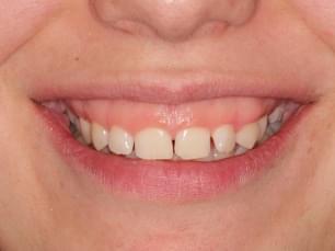 Antes y después de estética dental