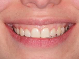 Resultados de estética dental