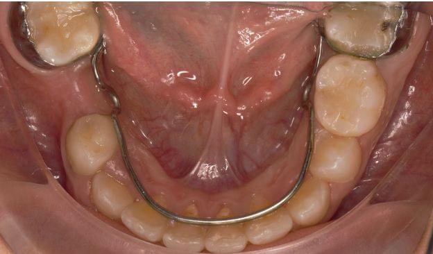 Revisión dental infantil