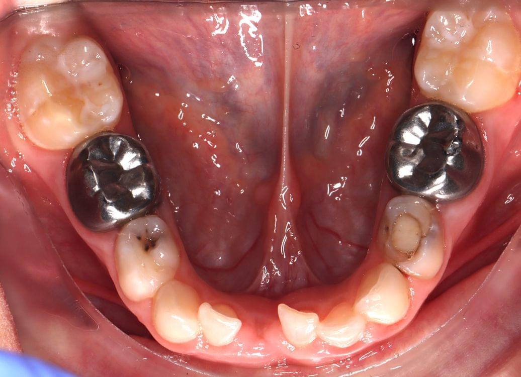 Tratamiento dental para niños