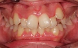 Antes y después del tratamiento de ortodoncia