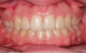 Resultados del tratamiento de ortodoncia