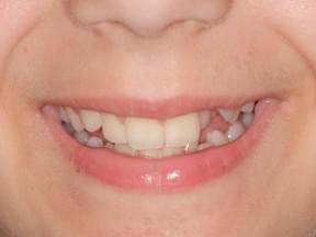 brackets metálicos en tratamiento