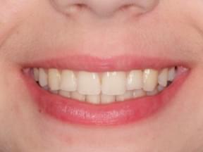 brackets estéticos en tratamiento