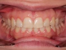 Alineación dental con brackets