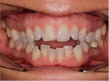 Resultados con ortodoncia invisible