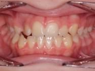 Antes y después ortodoncia invisible