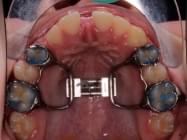 Transformación dental con Invisalign