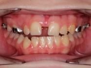 Sonrisa perfecta después de ortodoncia