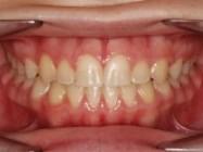 Resultados finales de ortodoncia